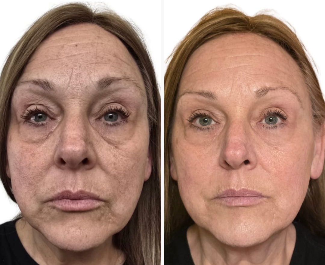 Neora before and after result